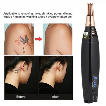 

Skin Spots Removal Pen, Wart Remover ,scar Removal Machine, Blue Promote Skin Metabolism Electric Picosecond Pen Vamsluna 110V