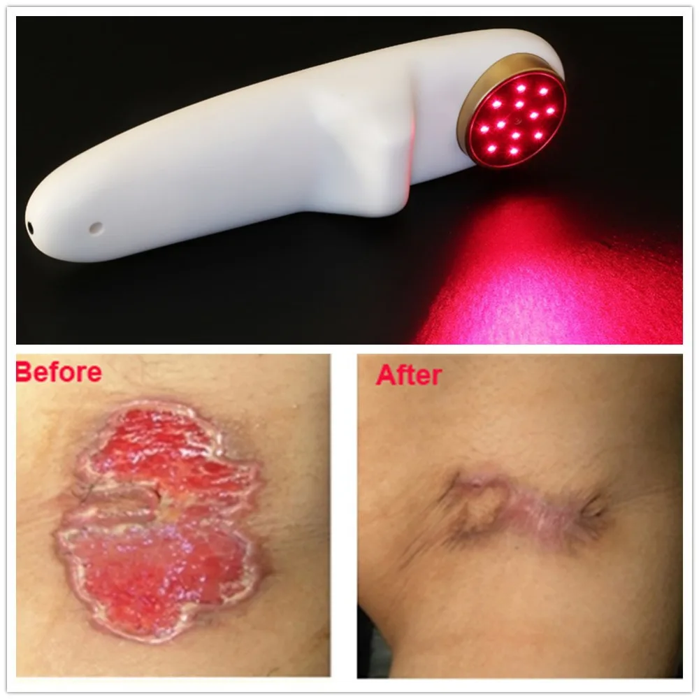 

Cold Laser LLLT 808nm Red Light Therapy Treatment for Rheumatic Pain Relief,Sport Injuries, Arthritis,Wounds Healing