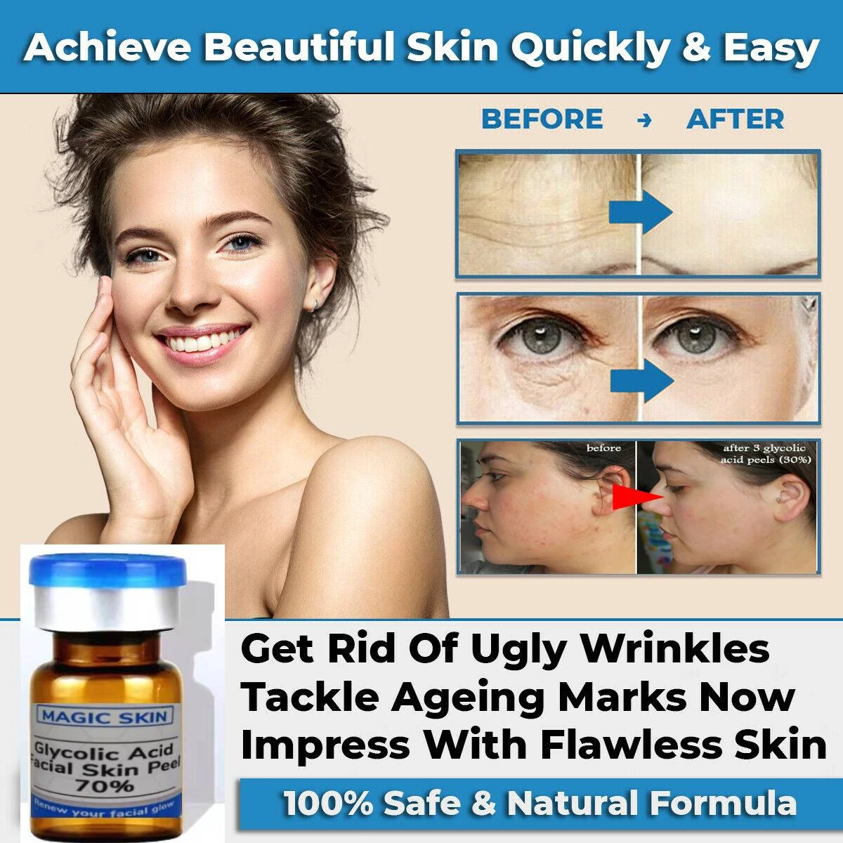 Glycolic Acid Facial Skin Peel 70 Chemical Chemical Peel For