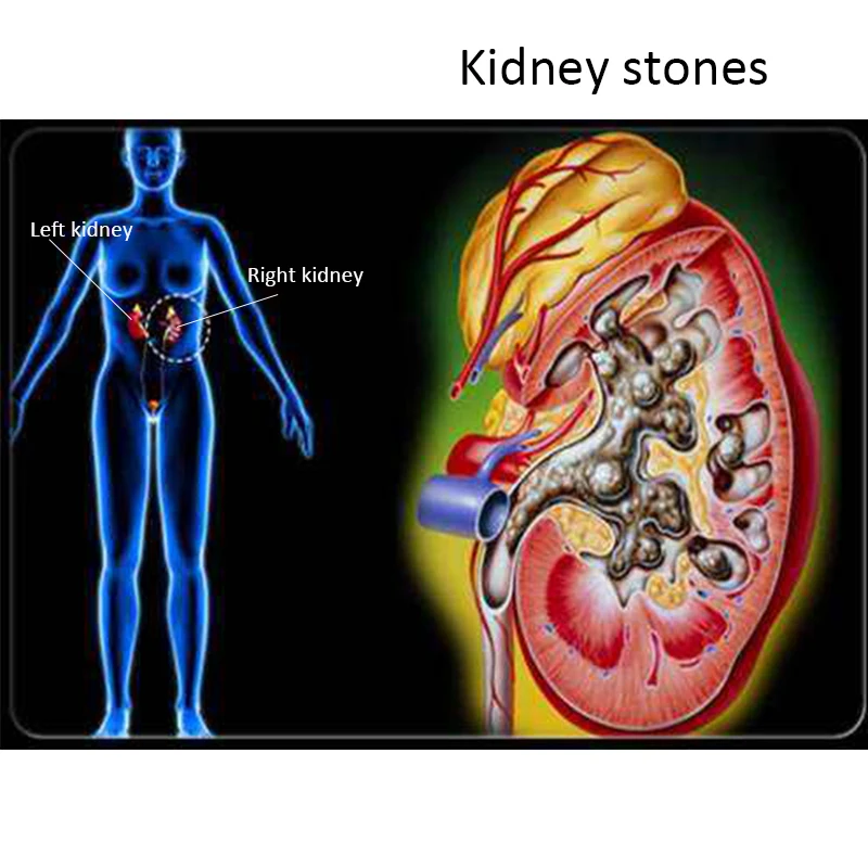 40 pcs/2 Packs Kidney Stone Cleaning Tea gallbladder Kidney stone treatment cleaning kidney gallstone product draining Stone tea