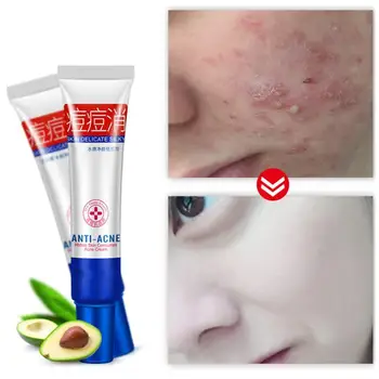 

WH 30g Remove Acne Scar Face Care Skin Treatment Cream Oil Control Care Face Pores Blackhead Cream Acne Shrink Scar Removal S6T2