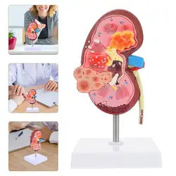 Modèle pathologique de rein humain, 1 pièce, modèle de corps humain, démonstration d'enseignement 