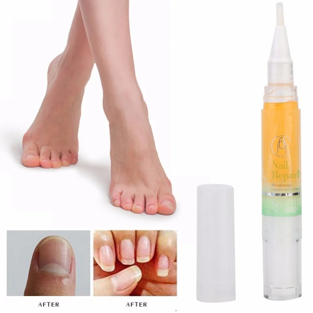 5ml Fungal Nail Repair Treatment Liquid Toenails Fingernails Fungus Removal Fluid