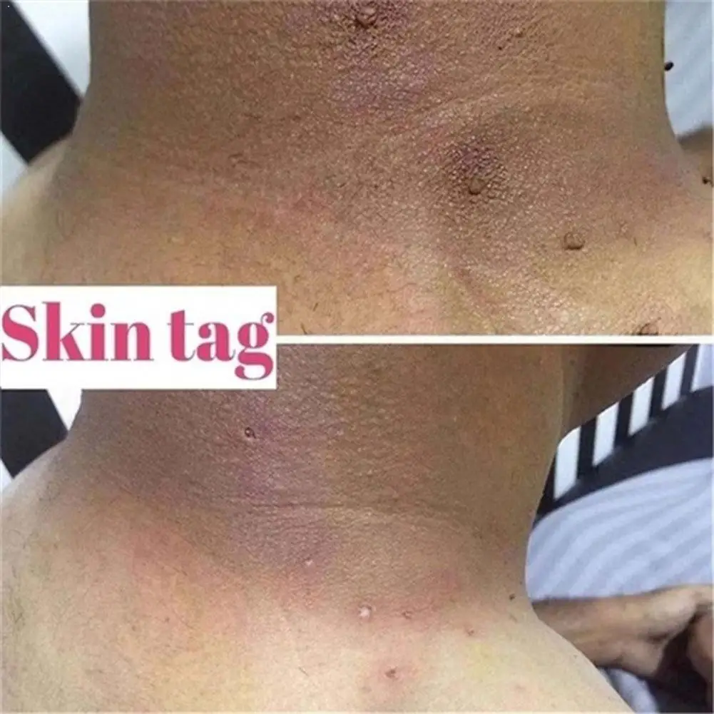 

Ultra Strength Natural Health Mole Nevus Wart Skin Foot Skin Treatment Warts Tag Corn Removal Tag Y2H4