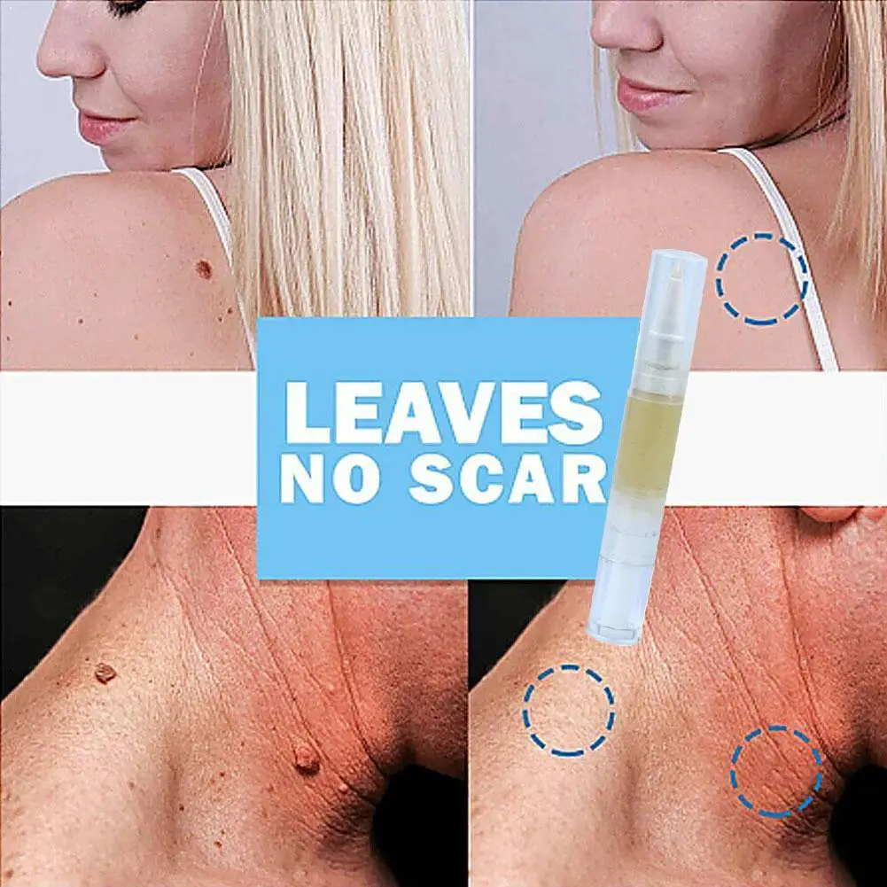 

5ML Skin Tag Remover Warts Treatment Against Mole Wipe Remover Off & Tags Moles M4H7