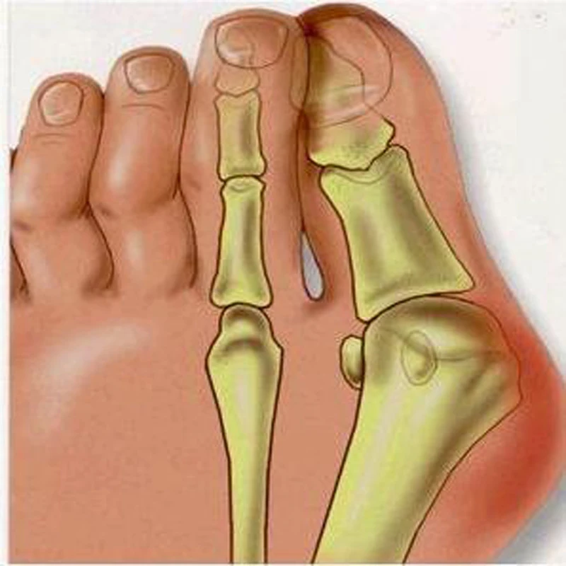 1Pair Bunion Protector Feet Care Orthotics Pedicure Tool Hallux Valgus Corrector Orthopedic Adjuster Foot Massager
