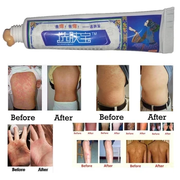 Skin Care Herbal Body Cream Psoriasis Cream Dermatitis Itching Repair Eczematoid Ointment Treatment Psoriasis Eczema