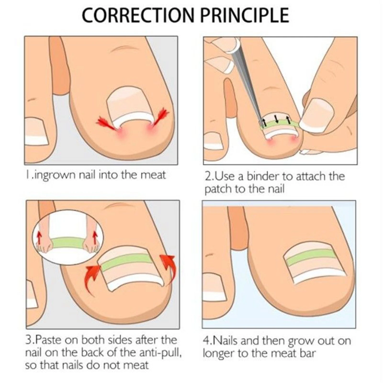 Ingrown Toenail Straightening Clip Curved Brace Toenails Thick