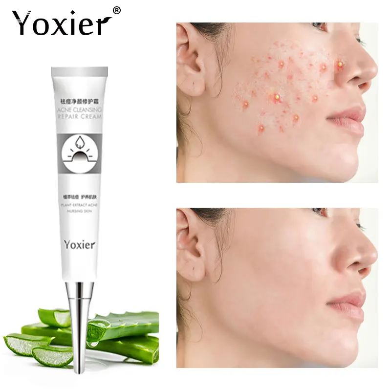 

Acne Cleansing Repair Cream Removal Pimple Blackhead Oil-control Fades Acne Marks Shrink Pores Aloe Extract Face Skin Care 20g