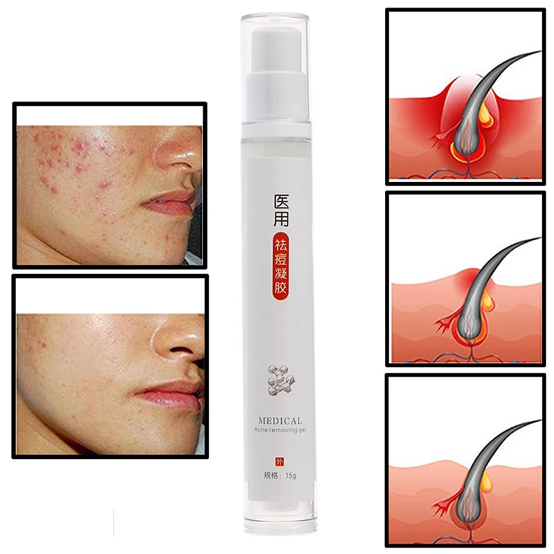 15ML Skin Care Face Acne Treatment Acne Scars Cream Anti Acne Removal Gel