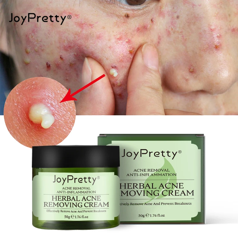 JoyPretty удаления прыщей уход за кожей травяной крем анти-лечение от Отбеливание