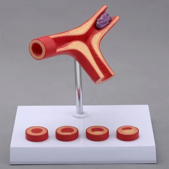 

human vascular Thrombosis model Medical teaching supplies Human Cardiovascular arteriosclerosis model