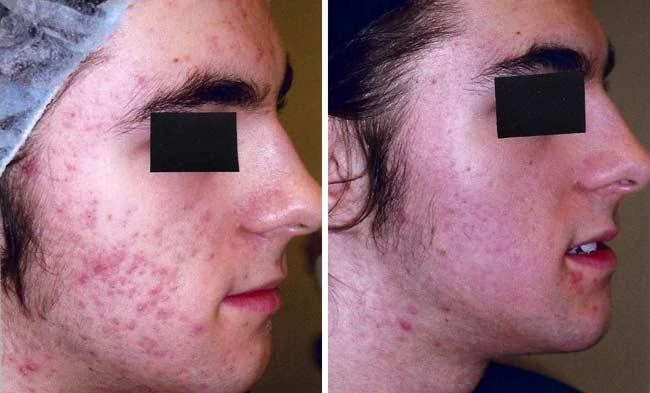 pimple free face cream