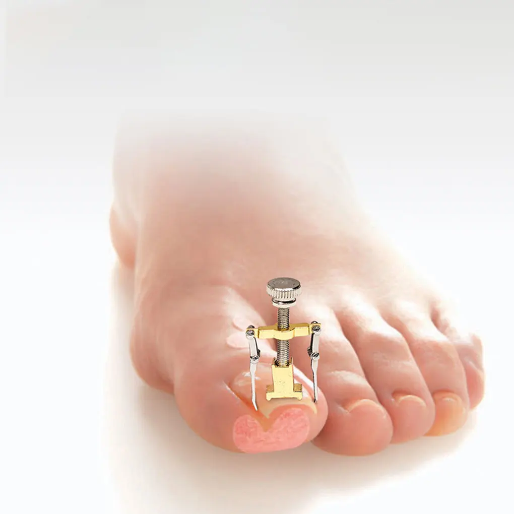 Professional Copper Ingrown Toenail Treatment Kit Toe Nail Correction Foot Care Correction Brace Tool