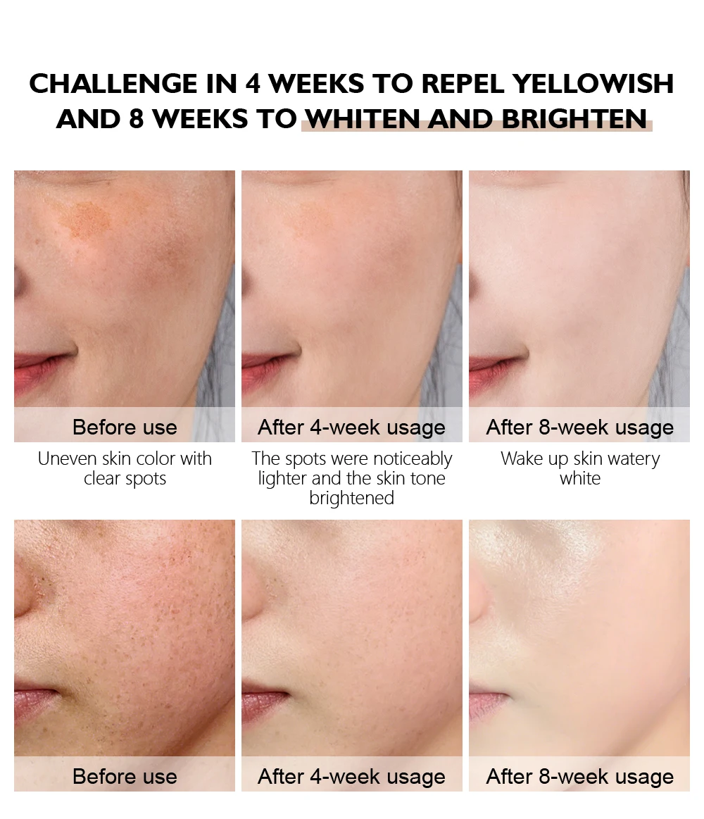 marcas de poros e acne, cuidado da pele facial, 30ml