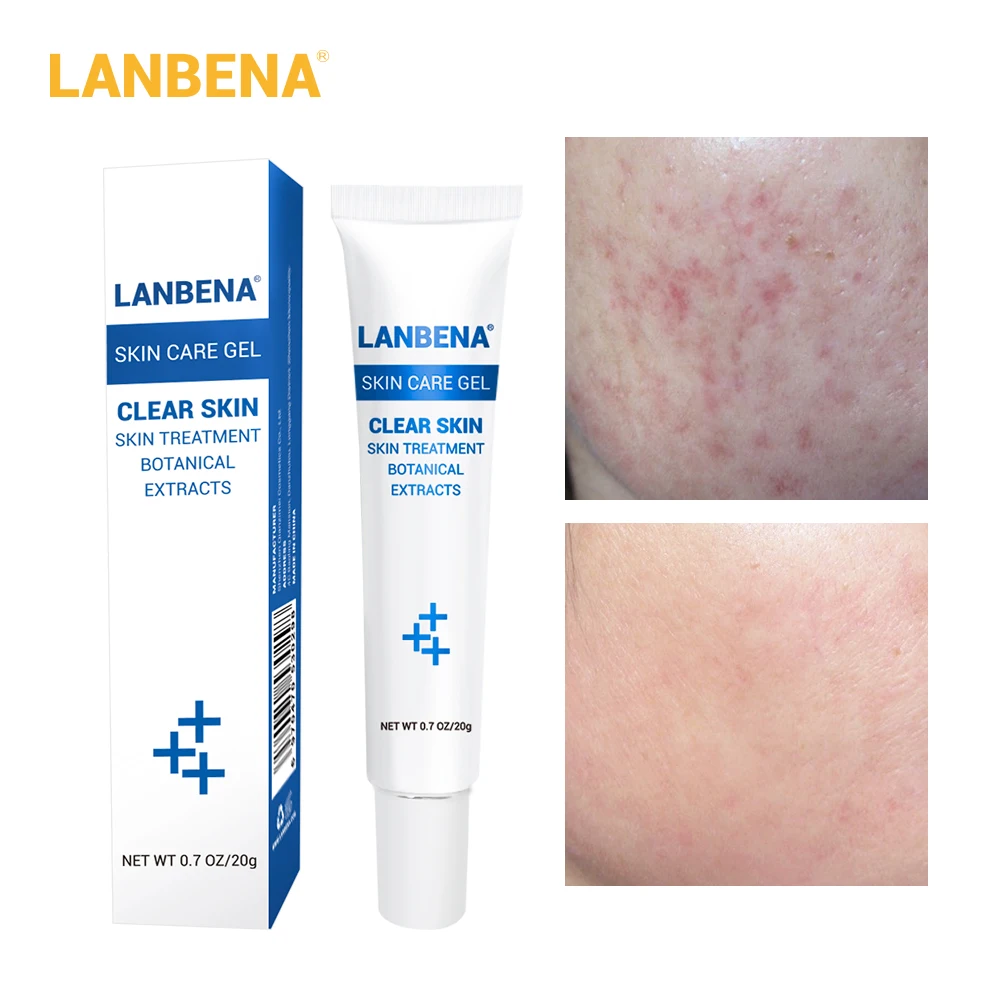 LANBENA маска для лица серия Acne Уход за кожей Гиалуроновая кислота сыворотка акне прыщи патч лечение акне гель для удаления прыщей крем для лица
