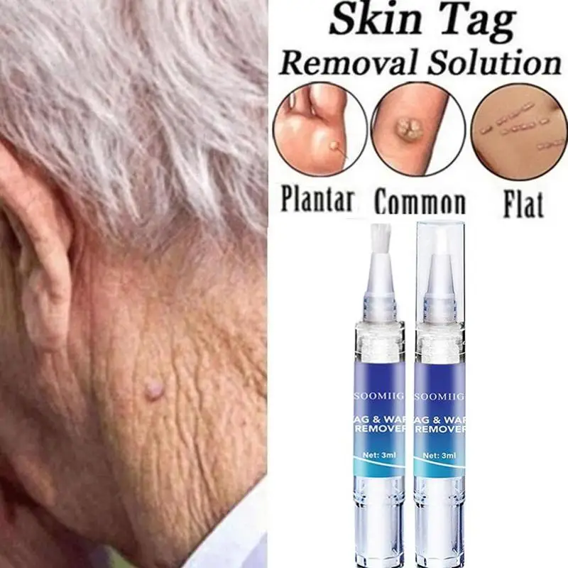 Skin Tag Remover Pen Natural Health Mole Wart Skin Corn Foot Tag Liquid Treatment Skin Care Warts Tag Removal Herbal Extract