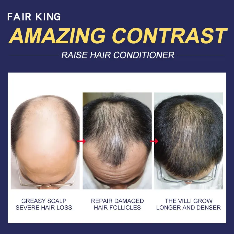 Produtos сделать Crescimento сделать Cabelo da перда де Cabelo Essência Da Árvore Do chá de Óleo эфирного Líquido Tratamento de Prevenção