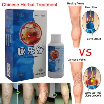 

60ml Vasculitis Spray Varicose Veins Treatment Spray On Leg Acid Bilges Itching Earthworm Lumps Bad Leg Cure Natural Solution