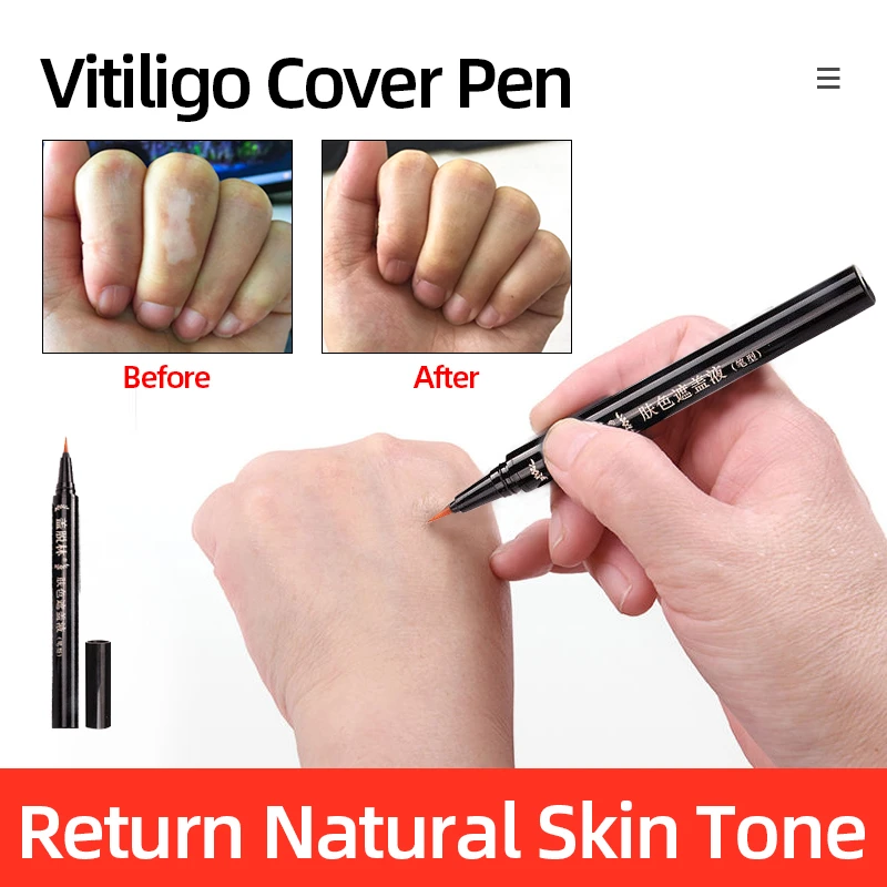 vitiligo concealer