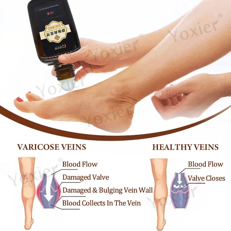 Varicose Veins Treatment Gel Repair