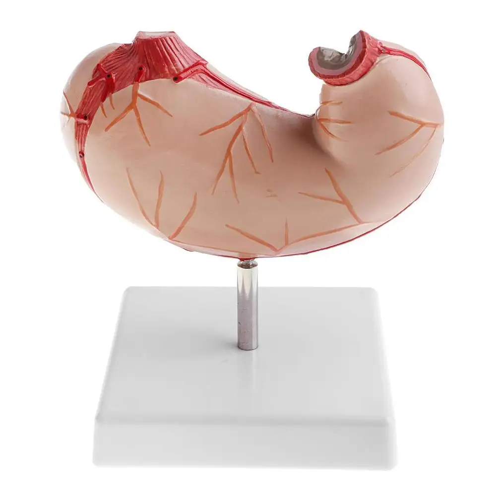 Съемная анатомическая модель с человеческим желудком 2 части 1:1 Lifesize|ulcer| |