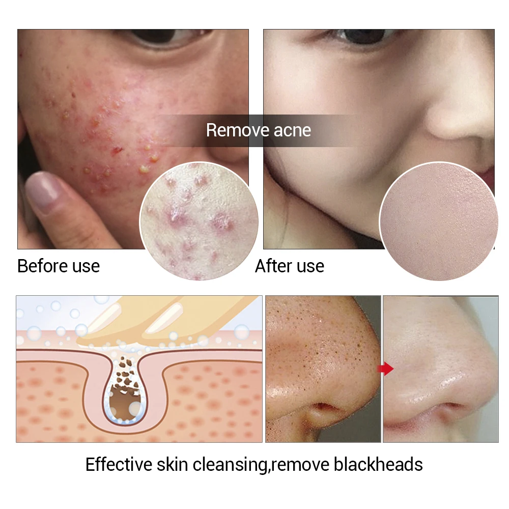 LANBENA Handmade Soap Tea Tree Essential Oil Facial Cleansing Acne Treatment Moisturizing Remover Anti-Aging Blackhead LANBENA Handmade Soap Tea Tree Essential Oil Facial Cleansing Acne Treatment Moisturizing Remover Anti-Aging Blackhead