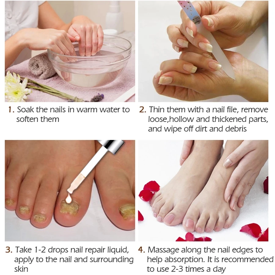 Nail Fungal Treatment Feet Care Essence Nail Foot Whitening Toe Nail Fungus Removal Gel Anti Infection Paronychia Onychomycosis
