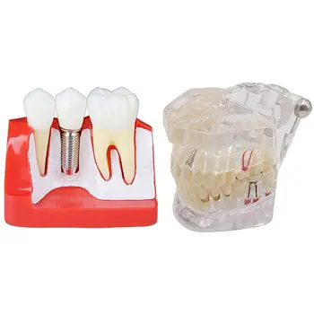 

2Pcs Oral Hygiene Implant Disease Teeth Model for Teaching PVC/Resin Oral Health Care Teeth Whitening Teeth Model