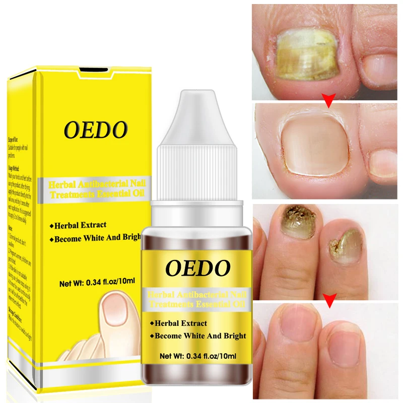 

OEDO Herbal Antiseptic Nail Repair Essence Oil Remove Nail Fungus Care Moisturizing Nourish Whitening Toe Repair Nail Liquid Pro