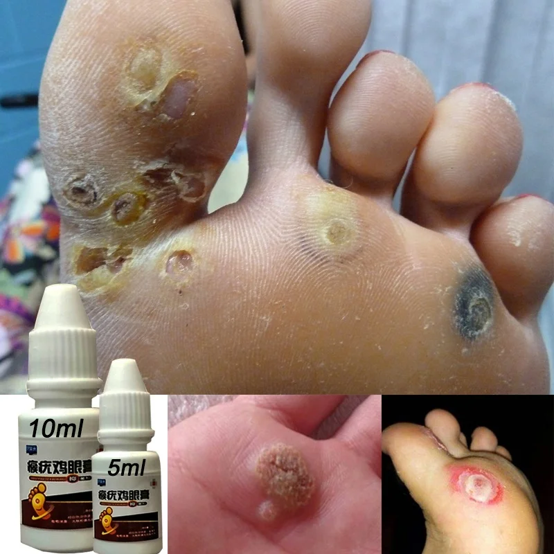 Papillomas-Removal Anti-Verruca of Warts-Liquid Wart-Treatment Removing-Against From-Skin-Tags