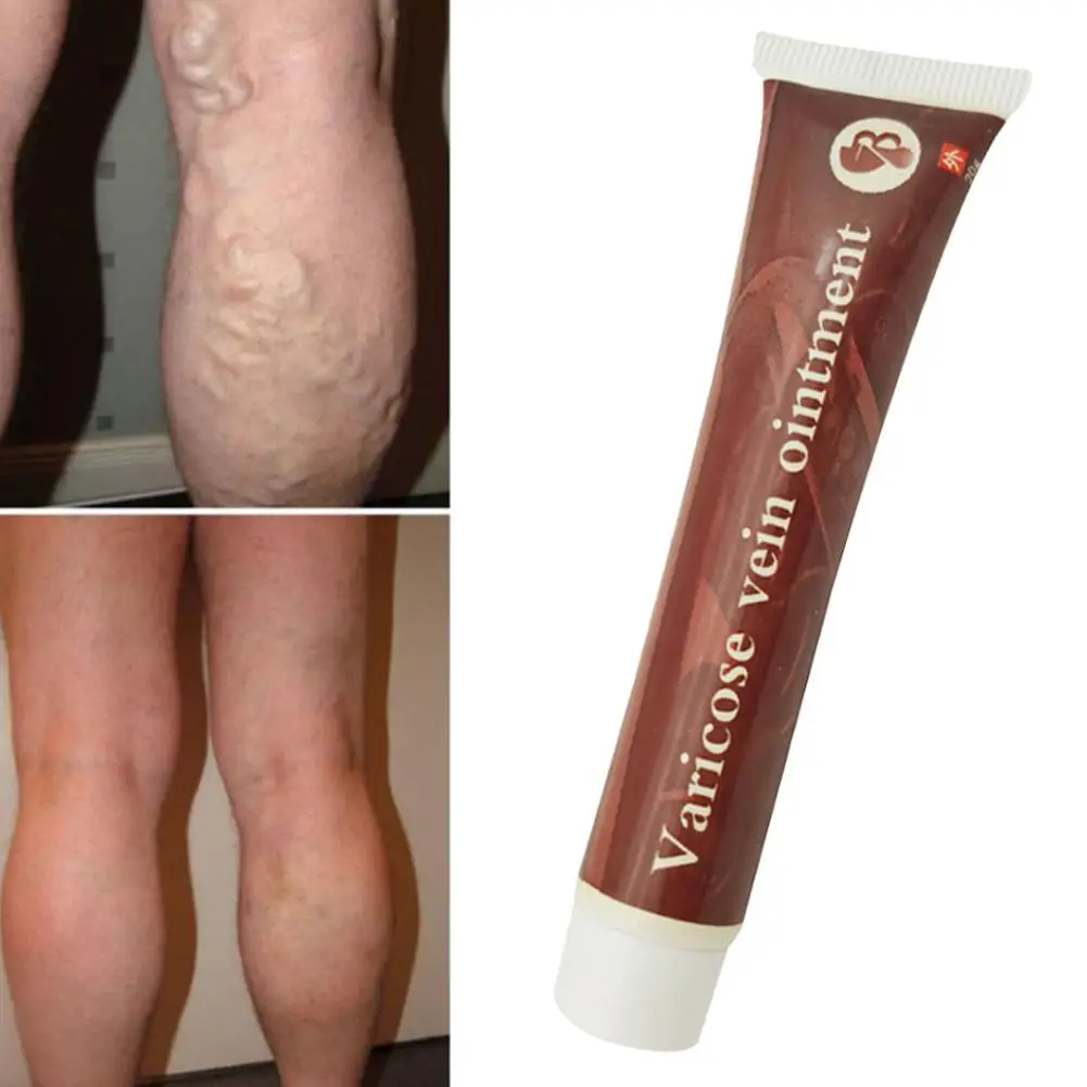 

Varicose Veins Treatment Cream Effective Cure Vasculitis Phlebitis Spider Veins Pain Varicosity Angiitis Ointment Health Care