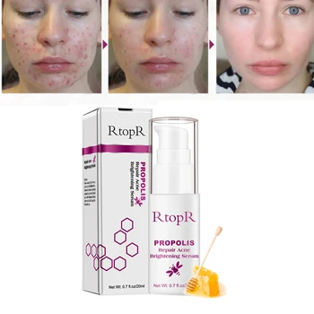 

RtopR Propolis Repair Acne Brightening Serum Acne Scar Spots Cleaning Serum Shrink Pores Eliminates Acne Treatment Oil Control