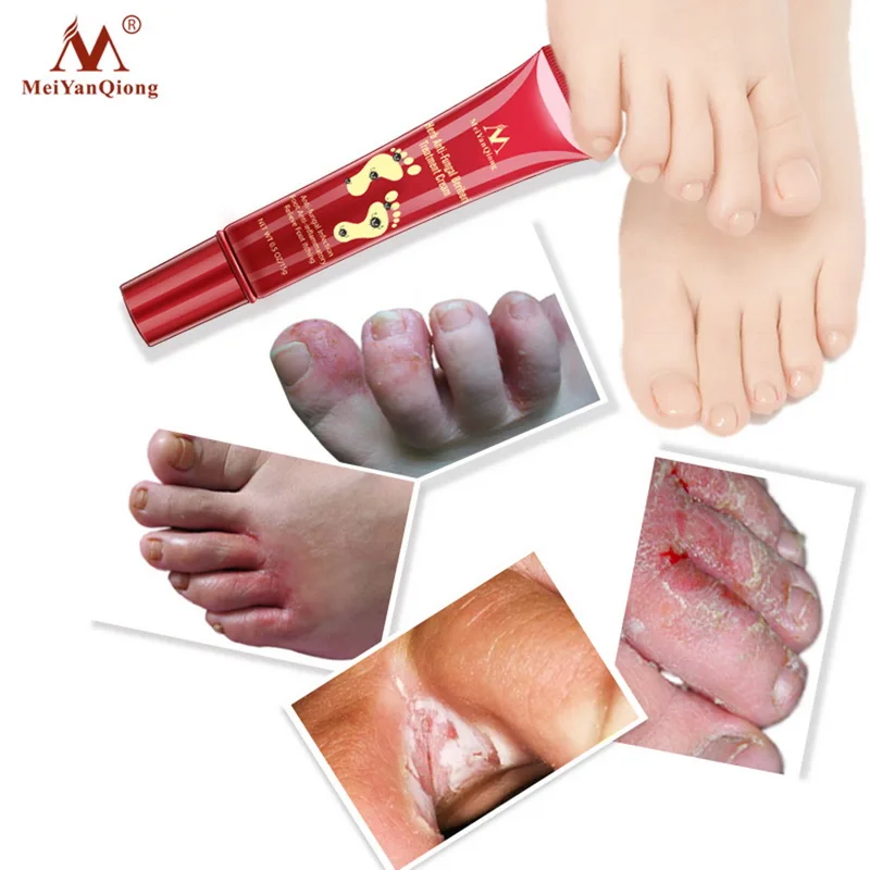 Травяное эффективное лечение ног против грибковой инфекции onychomicosis Paronychia Toe Fungus Treatment крем для ухода за ногами