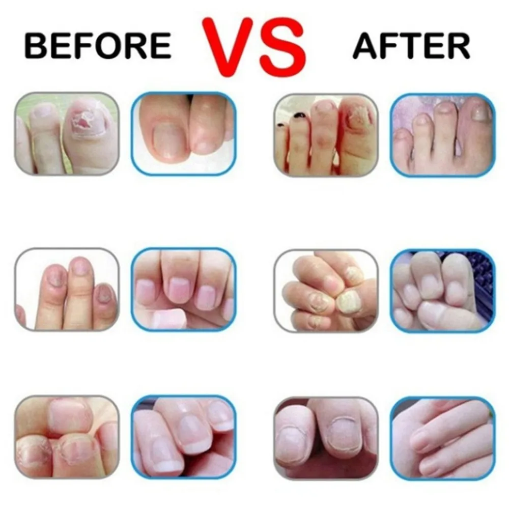 12 мл натуральный травяной уход за ногтями Бережный уход за кожей ...