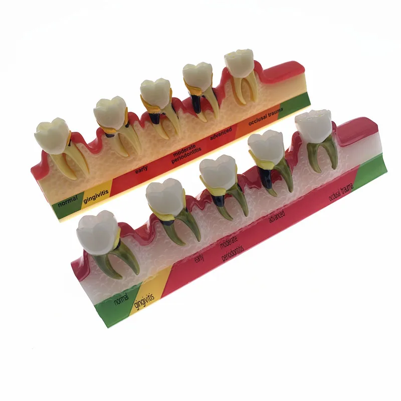 

Dentist Odontologia Periodontal Disease Dental Teeth Model Tooth dental Model