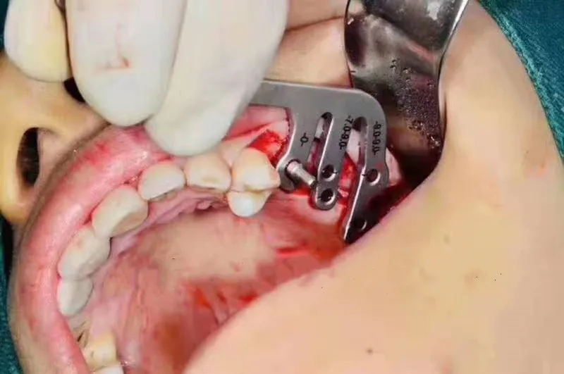 Стоматологические имплантаты инструменты оральная посадка позиционирование руководство зубной имплантат инструменты посадки позиционирования угол линейка стоматологические инструменты