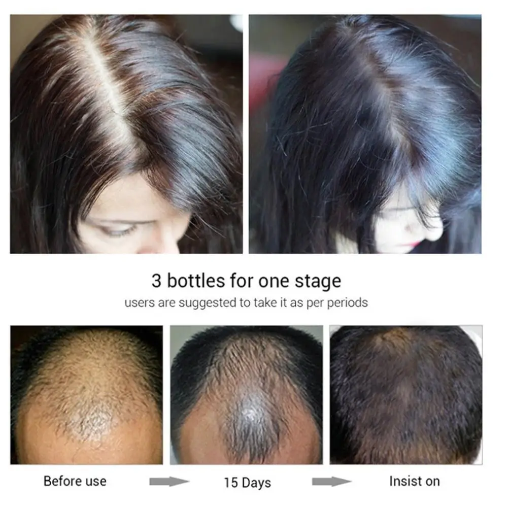 Горячая Putimi Уход за волосами рост против выпадения волос Предотвращение здравоохранения Красота Сыворотка для роста густых волос продукты