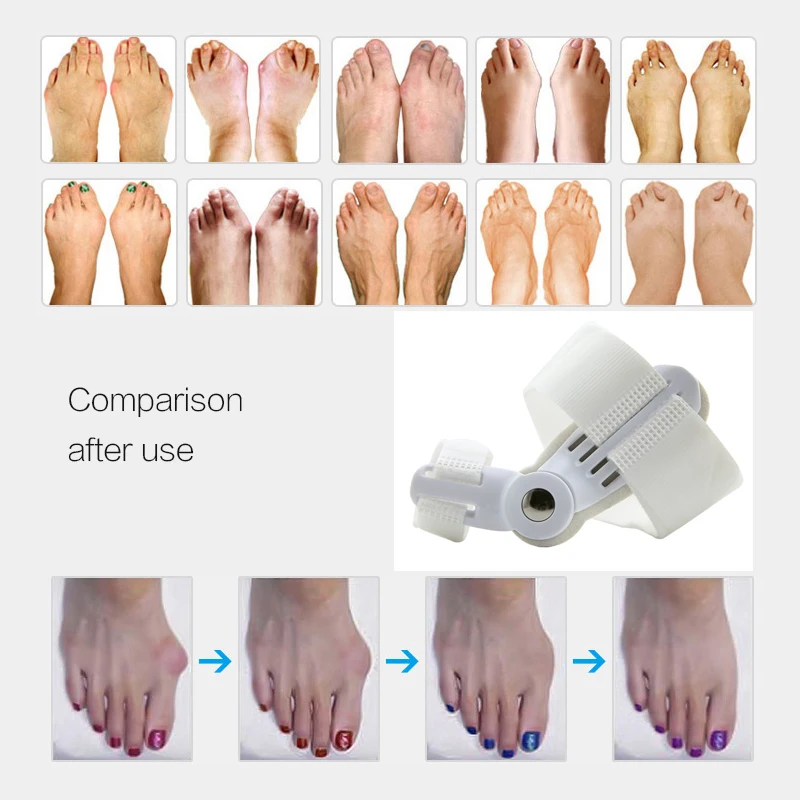 1Pcs Hallux Valgus Splint Corrector Bunion Thumb Bone Orthopedic Finger Big Toe Separator Straightener Pedicure Foot Care Tool