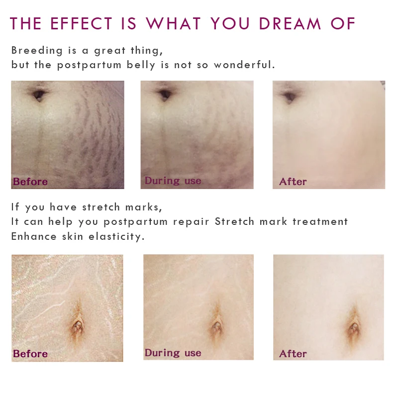 Крем для удаления шрамов беременных с манго крем от акне растяжки лечение против