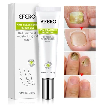 

Nail Repair Cream Fungal Nail Treatment Serum Foot Nails Fungus Removal Gel Anti-Infection Onychomycosis Repair Essence TSLM1