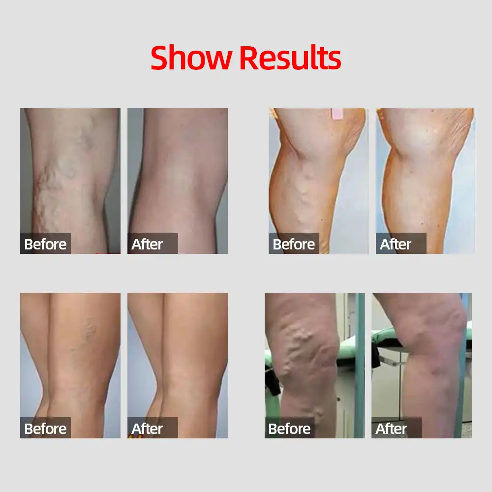 Retete populare din recenzii varicose recenzii - Tratament remedii populare picior varicose