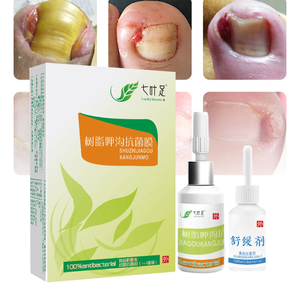 Onychomycosis упрочняющий грибок для ногтей безболезненный лечение рогового пальца ног портативный профессиональный пароникский мазь Набор Крем Agentia