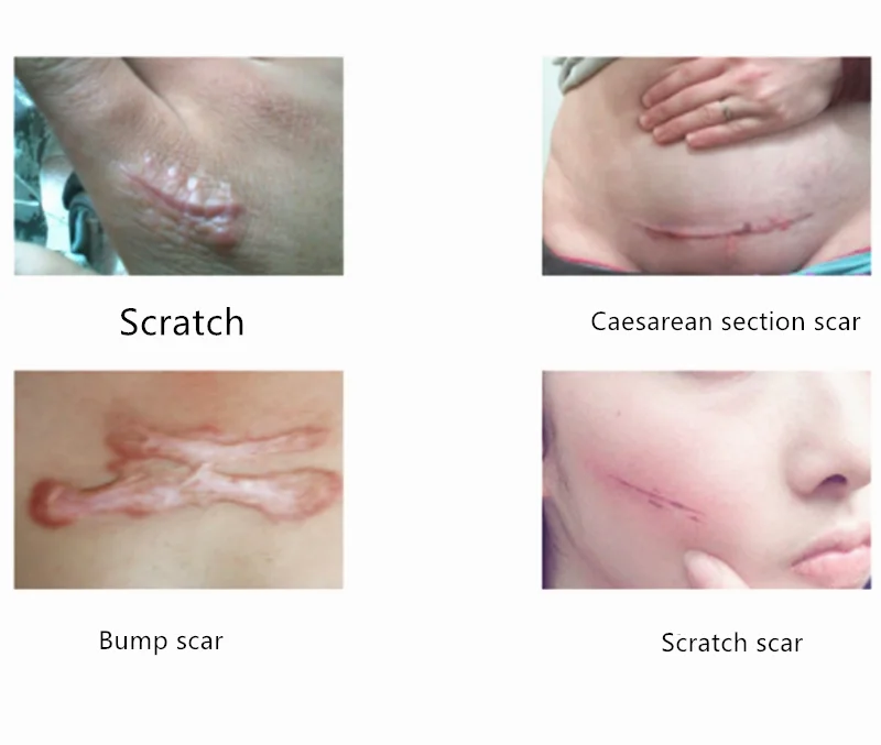 

1pc Silicone Removal Scar Sticker 5x3.5cm Reusable Acne Gel Scar Therapy Silicon Patch Remove Trauma Burn Sheet Skin Repair Scar