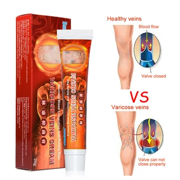 

Treatment Cream For Varicose Veins Chinese Herbal Medicine For Vasculitis Phlebitis Legs Veins Ointment