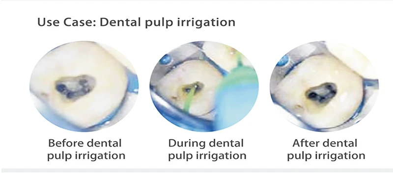 ativador sônico do irrigador do canal da raiz com arquivos endo dos pces para ferramentas endodontic do equipamento da odontologia da limpeza com dicas