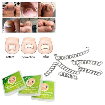 

3pcs/set Pedicure Acronyx Wire Nail Ingrown Correction Wire Patch Foot Care Paronychia Correction File Spring Ingrown Toe Tools