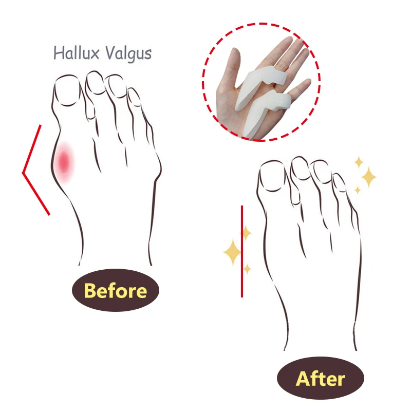 2Pcs Big Toe Bone Straightener Thumb Valgus Protector Silicone Gel Foot Care Fingers Toe Separator Bunion Adjuster Feet Massager