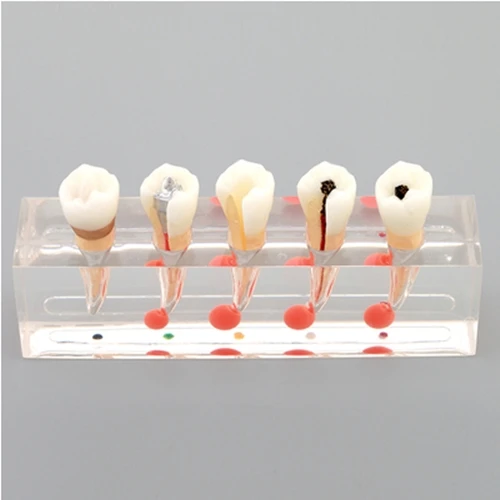 

1PC Dental Teeth Model Detachable Premolar teeth caries Education Study model