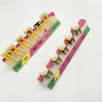 

2 Types Periodontal Disease Assort Tooth Typodont Model Study Teaching Model for Dental Lab Supplies
